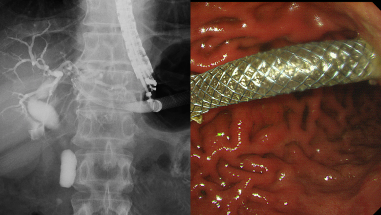 超音波内視鏡を用いた診断・治療